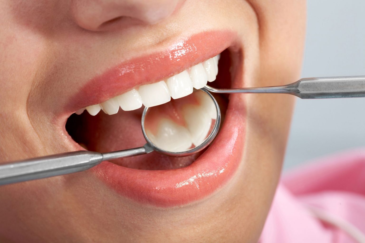 Dental sealants destination dental calgary
