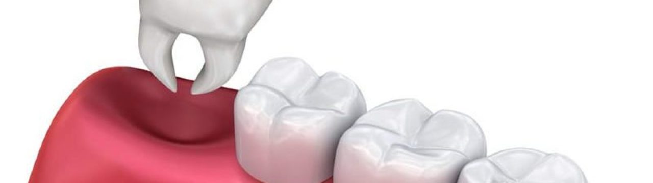 Extractions at calgary dentist